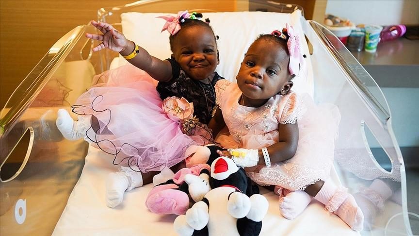Cameroonian conjoined twin sisters successfully separated by Turkish doctors