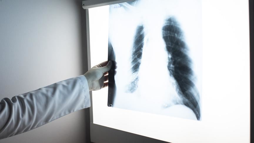 27,500 people in Turkey are diagnosed with lung cancer every year