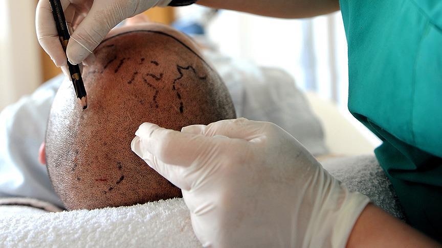 Турецкий хирург произвел революцию в практике пересадки волос